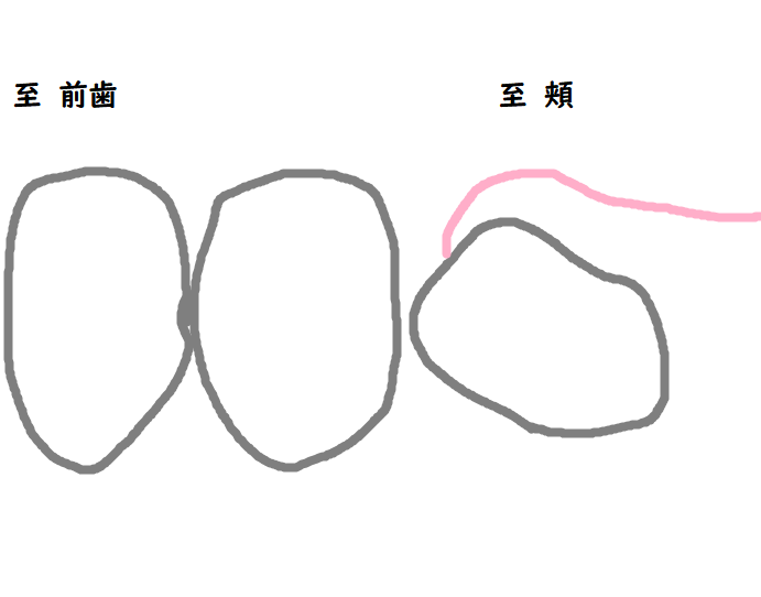 抜歯の準備