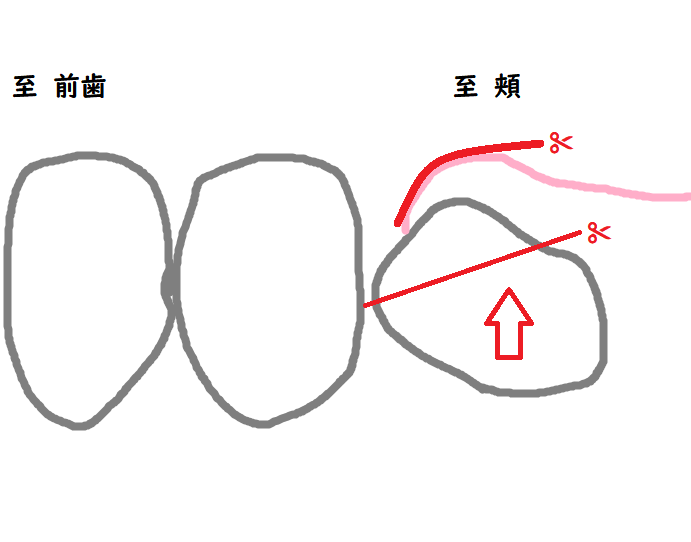 抜歯の計画