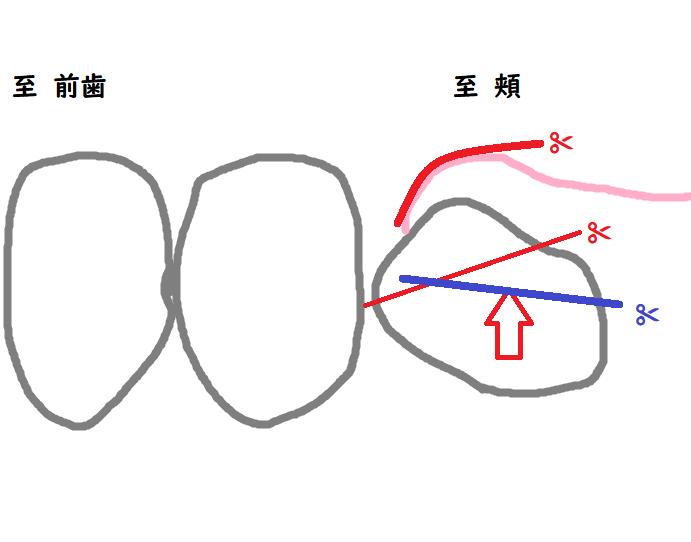 2抜歯の計画